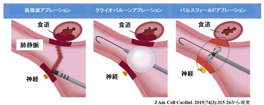 カテーテルアブレーション