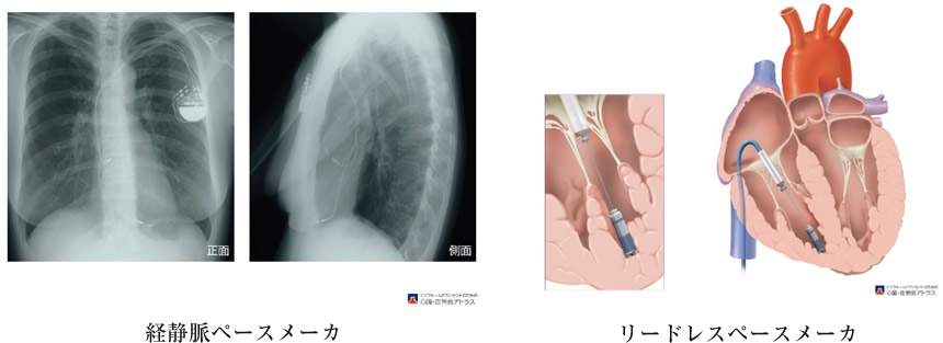 ペースメーカ/植込型除細動器